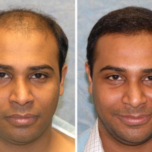 Building Confidence with a Hair Transplant