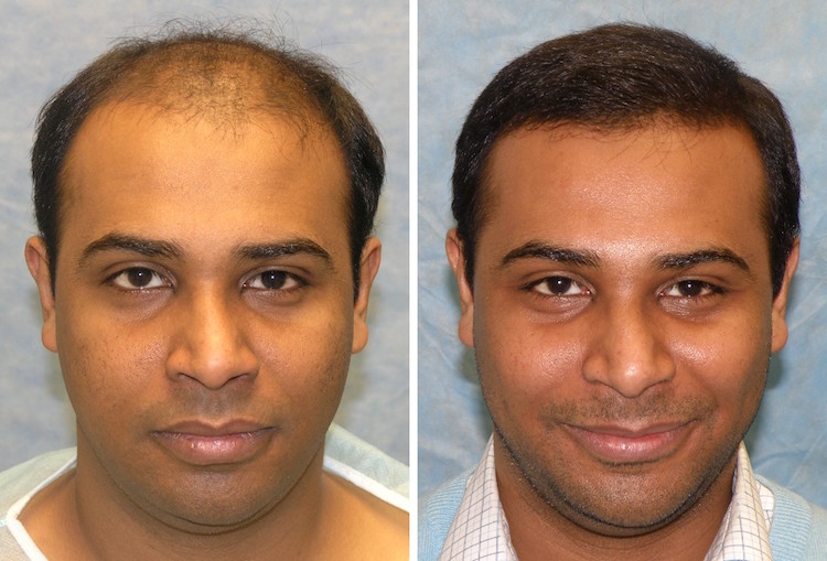 Building Confidence with a Hair Transplant