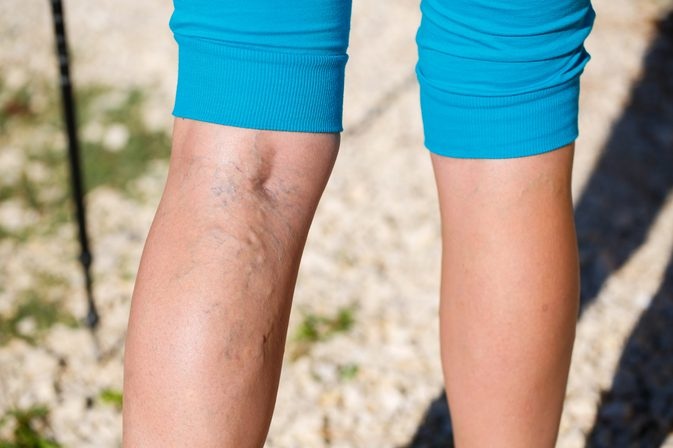 Summer Decision: Varicose Vein Treatment or Wearing Makeup On Ugly Veins