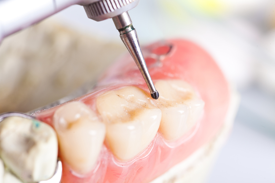 How To Properly Recognize and Address Tooth Filling Leaks