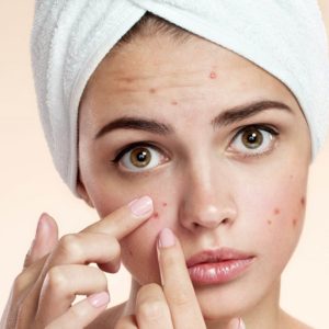 CBD Oil Did Really Cure My Acne