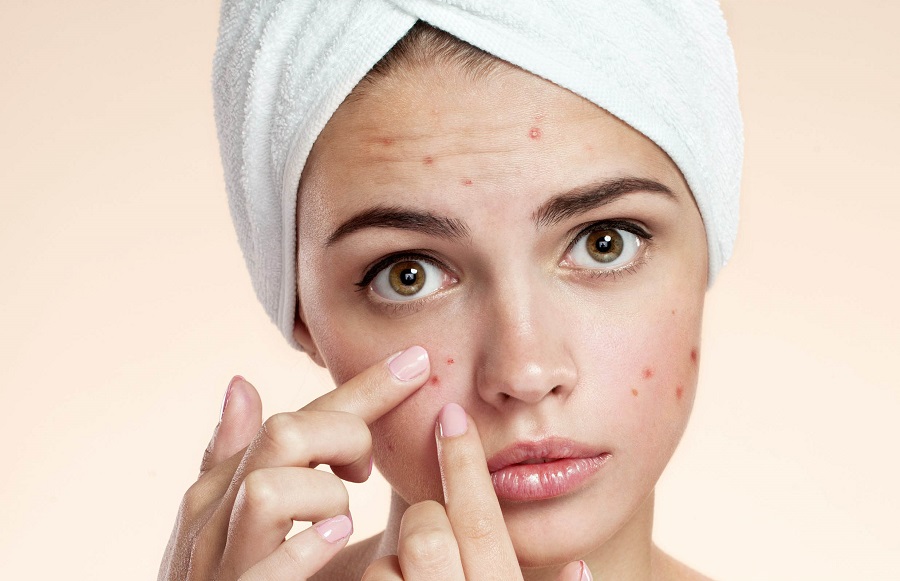 CBD Oil Did Really Cure My Acne
