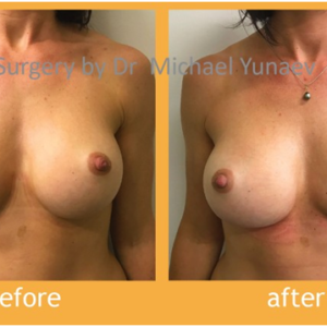 Enhance the size of your breasts, and reshape them!