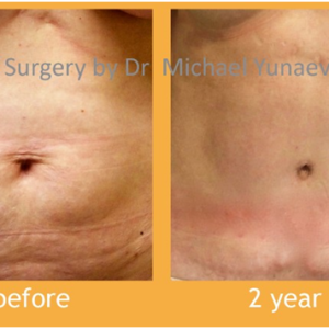 Get rid of stubborn fat!
