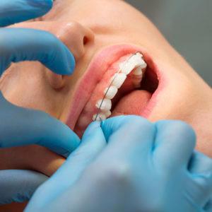 Traditional Braces