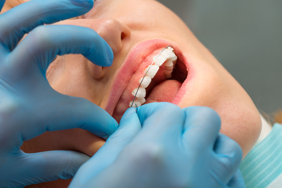 Traditional Braces