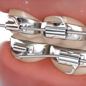 braces Raleigh NC