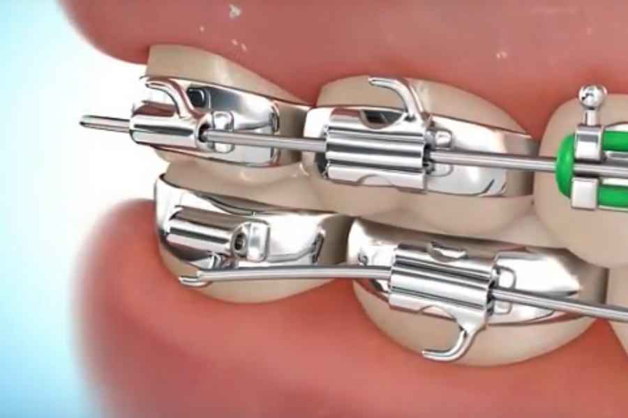 braces Raleigh NC