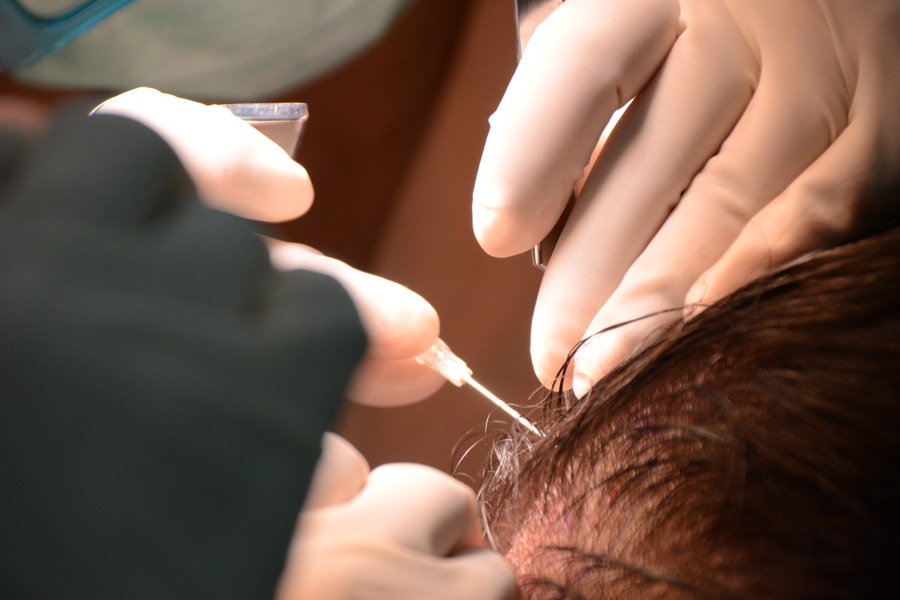FUE Hair transplant
