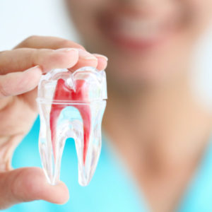root canal