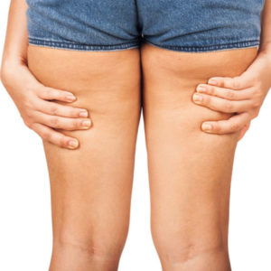 fighting cellulite