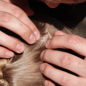 Scalp Issues