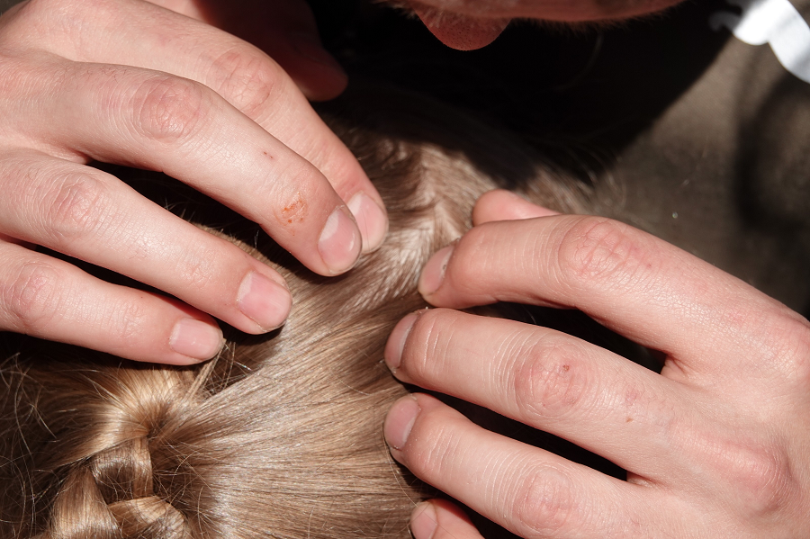 Scalp Issues