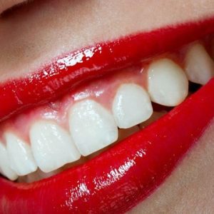 dental veneer implants in oklahoma city