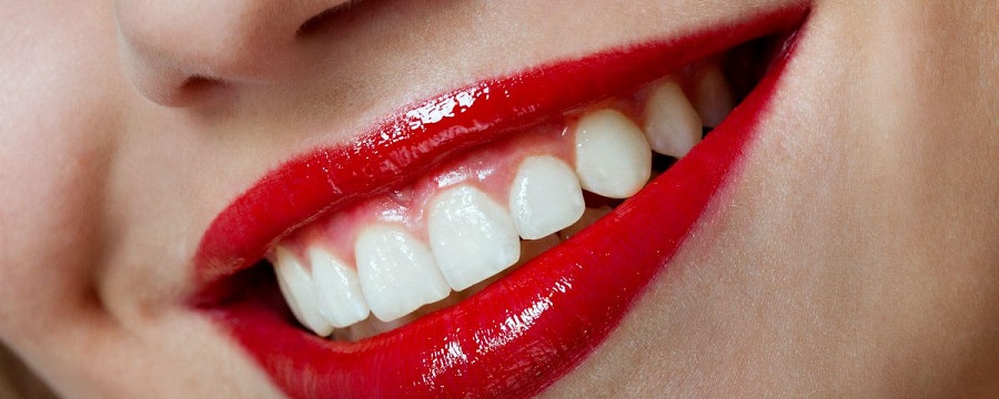 dental veneer implants in oklahoma city