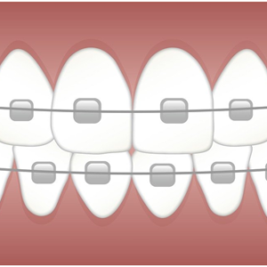 Top Reasons to Consider Orthodontics