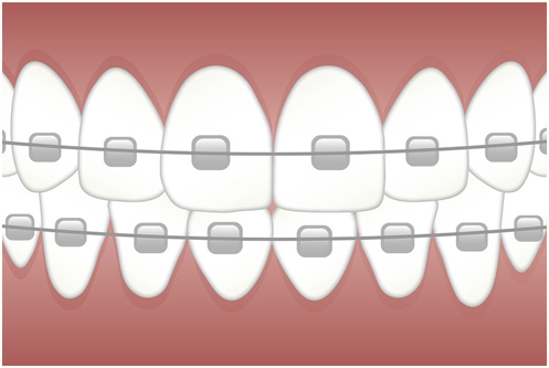 Top Reasons to Consider Orthodontics