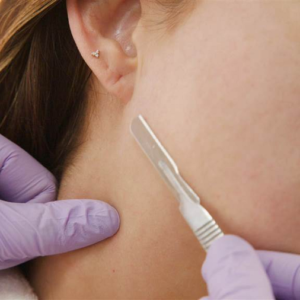 Dermaplaning