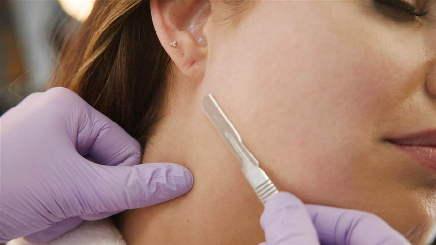 Dermaplaning