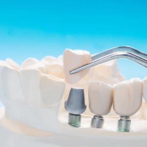 Dental Implant Misconceptions that Are Not True