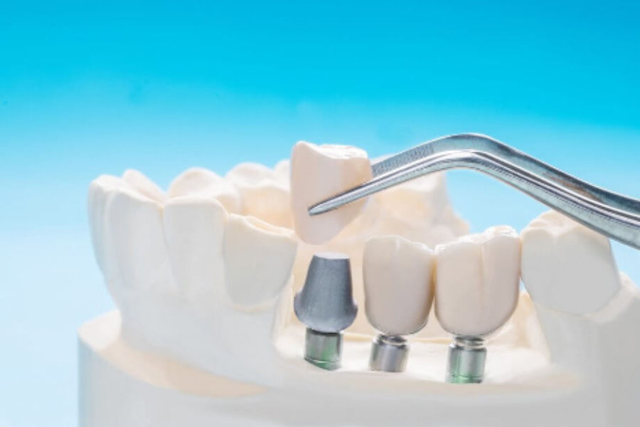 Dental Implant Misconceptions that Are Not True