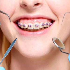 Extraordinary Pros Of Orthodontic Glassaligners That You Are Unaware Of