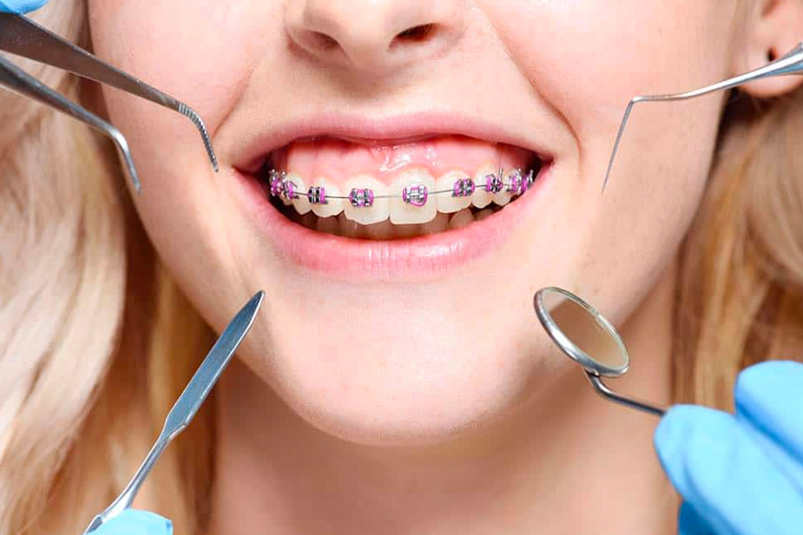 Extraordinary Pros Of Orthodontic Glassaligners That You Are Unaware Of