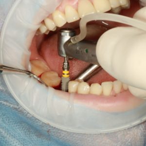 Myth- dental implants aren't as durable as your natural teeth.
