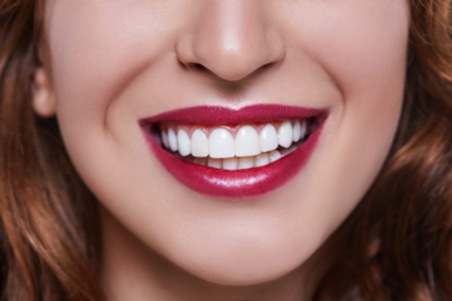 Useful Information About Dental Veneers