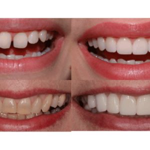 Veneers Materials
