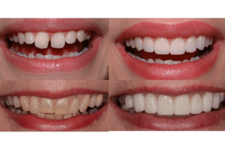 Useful Information About Dental Veneers Body Projex