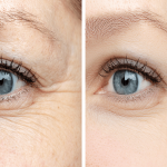 What Botox Can Do to Reduce Wrinkles