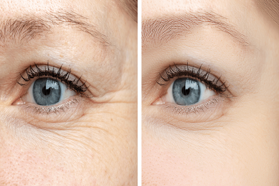 What Botox Can Do to Reduce Wrinkles
