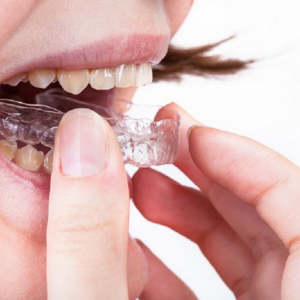 Invisalign Surrey