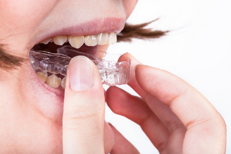 Invisalign Surrey