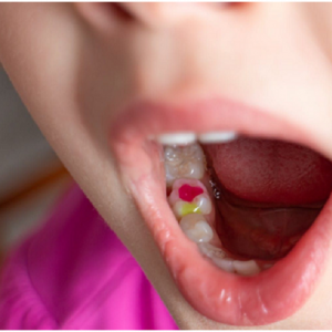 Tooth filling for kids