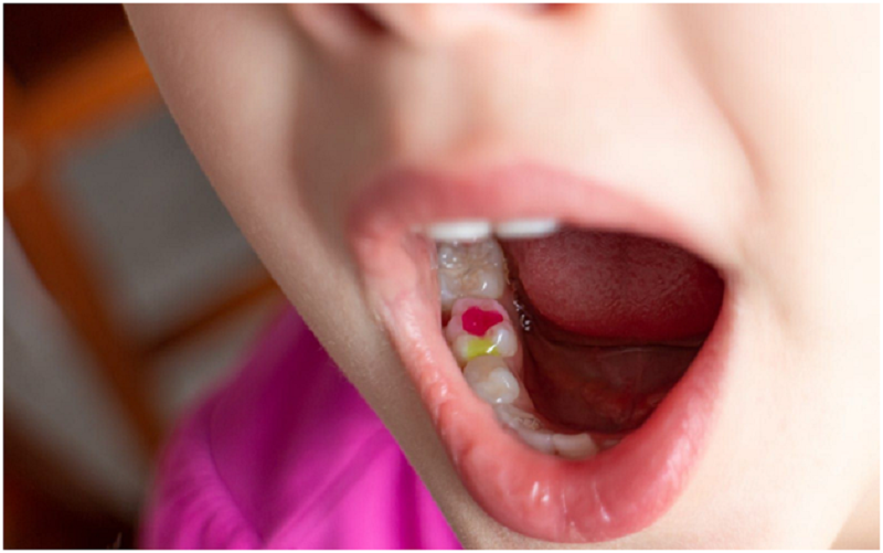 Tooth filling for kids