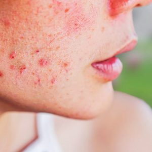How To Deal With Acne Prone Skin