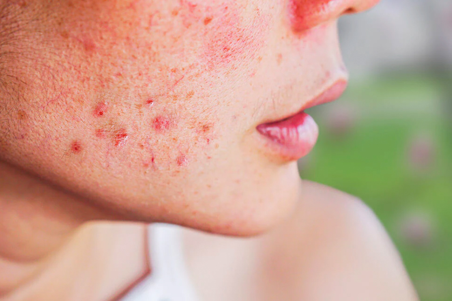 How To Deal With Acne Prone Skin
