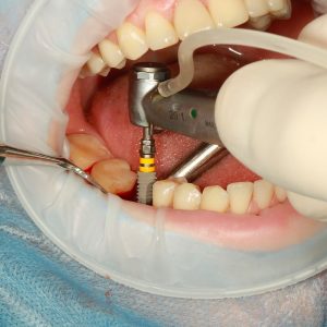 How much do Dental Implants cost in the UK