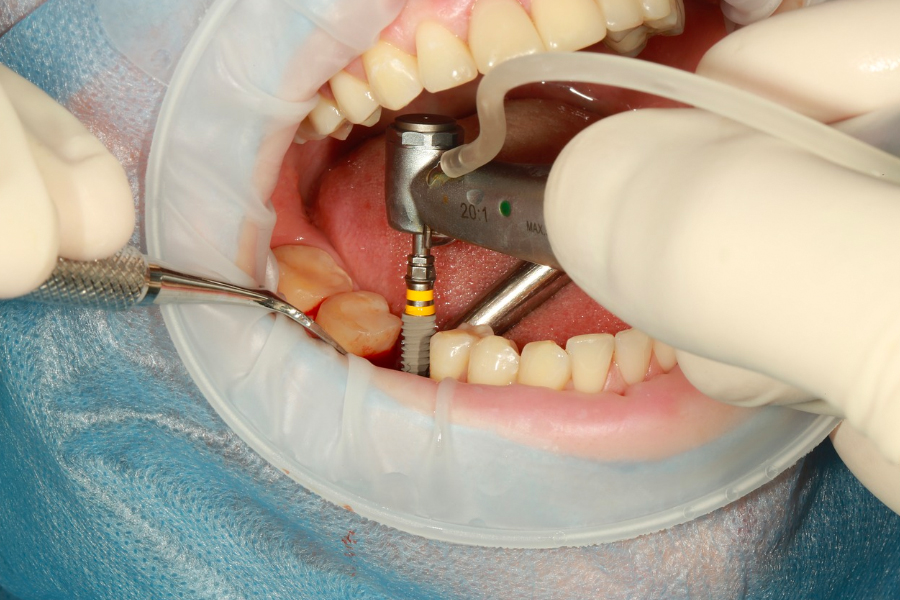 How much do Dental Implants cost in the UK