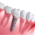Discover the Benefits of Dental Implants: Smile Confidently Again!