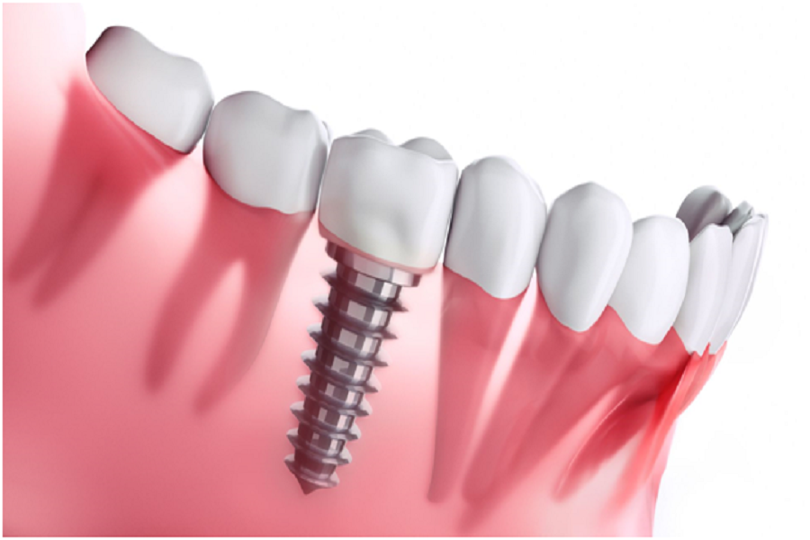 Discover the Benefits of Dental Implants Smile Confidently Again