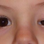 Ptosis: Know Its Untold Symptoms And Causes