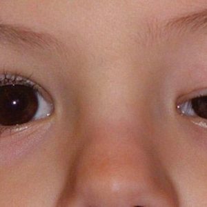 Ptosis Know Its Untold Symptoms And Causes