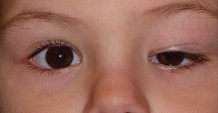 Ptosis Know Its Untold Symptoms And Causes