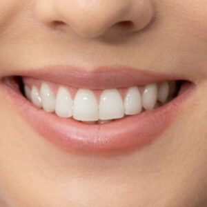 What Is the Best Cosmetic Dentistry Service for Smile Makeover