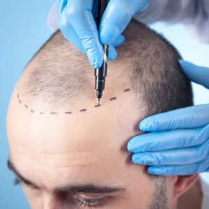 Should you go for hair weaving or hair transplant technique