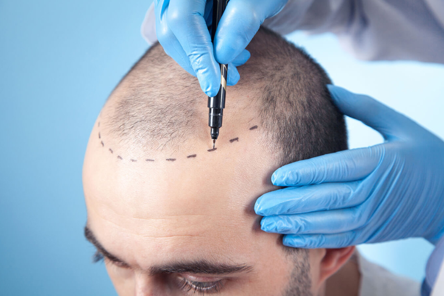 Should you go for hair weaving or hair transplant technique