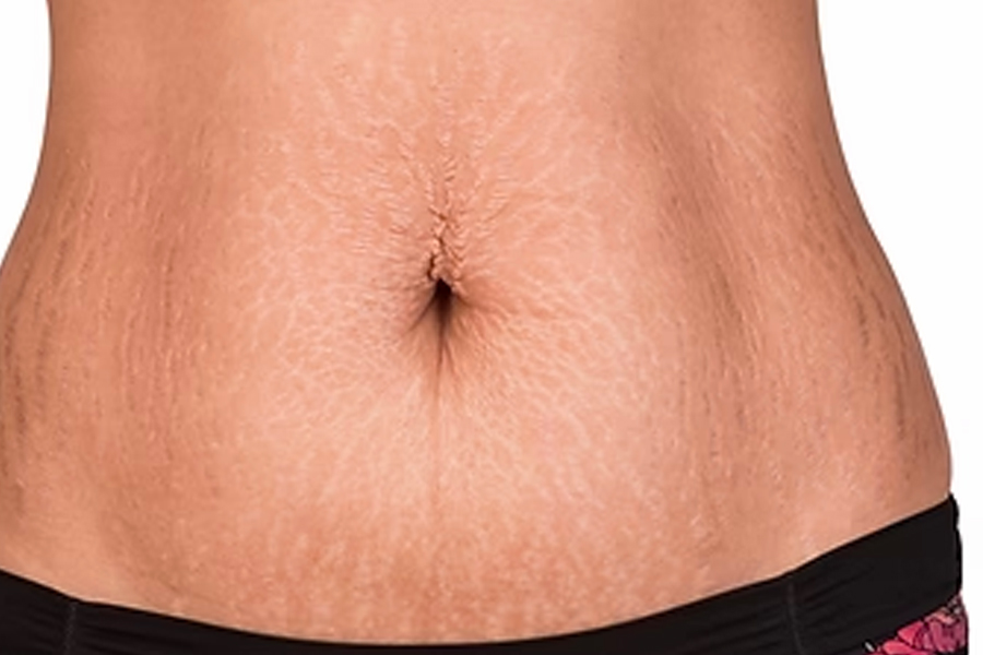 Revolutionary Laser Technologies for Stretch Mark Removal in Brisbane